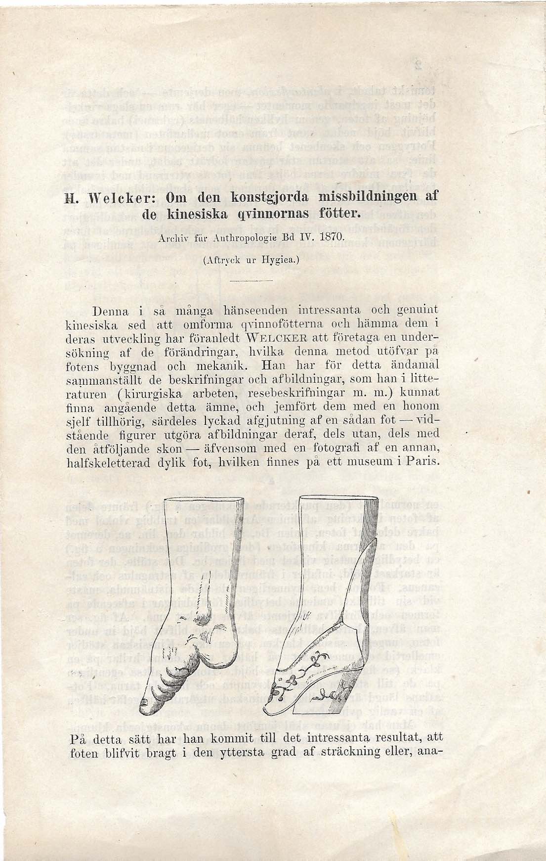RETZIUS, GUSTAF (Transl.) & WELCKER, HERMAN: - Om den konstgorda missbildningen af de kinesiska qvinnornas ftter. (About the artificial deformity of Chinese women's feet). Stockholm 1872.